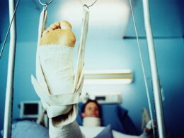 Medical Negligence Broken Leg Cases